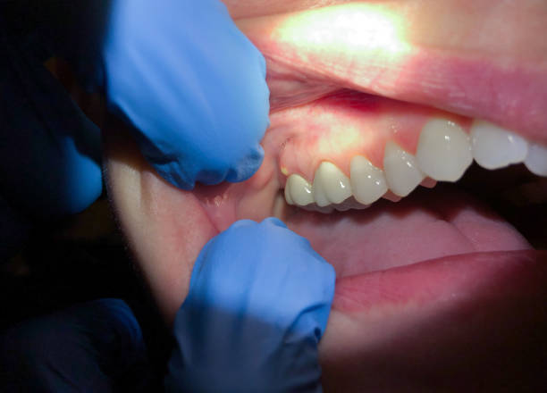 Best Knocked-Out Tooth (Avulsed Tooth) Treatment in Walled Lake, MI